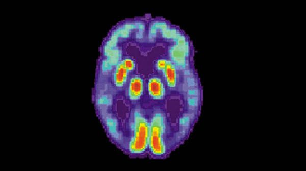  3. Farmaci contro l’Alzheimer 