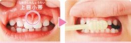 上唇小帯,0歳,予防歯科,ハミガキ