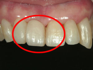 コンポジットレジンで作ったブリッジ