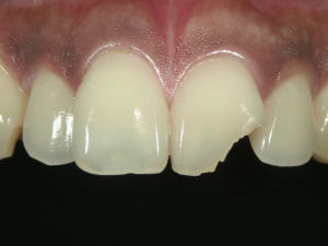 折れてしまった歯