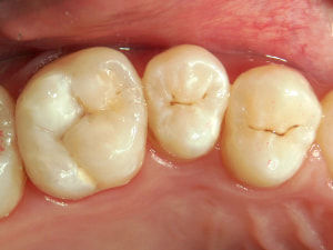 コンポジットレジンを充填して形を整える