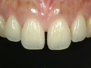 隙間が開いた前歯