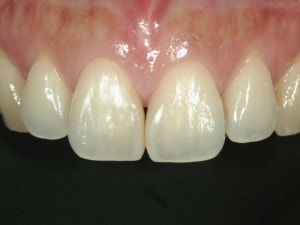 ２本の歯を少しずつ大きくして隙間を詰めた