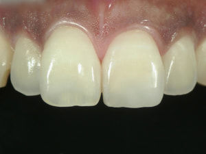 コンポジットレジンで歯を修復