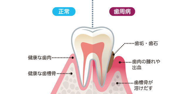 歯周病予防