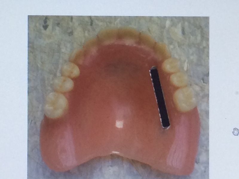 スウェーデンの義歯刻印は国民のID番号が使われている(千葉大学・斉藤准教授提供)